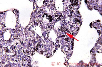 <i>Pneumocystis</i> 実験感染ヌードマウスの肺組織 (Grocott染色像) : H&E染色所見で肺胞腔内に認められる泡沫状物質内に好銀性 (黒色) の<i>Pneumocystis</i> 嚢子 (矢印)